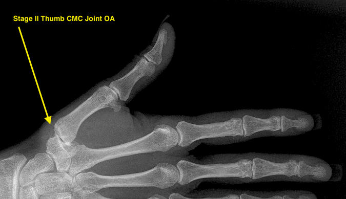 Osteoarthritis Carpometacarpal Cmc Joint Of Thumb Hand Surgery Resource 9774